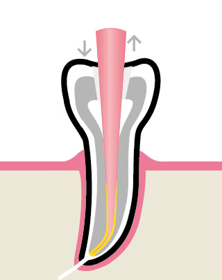 Вертикальная конденсация - установка мастер-штифта